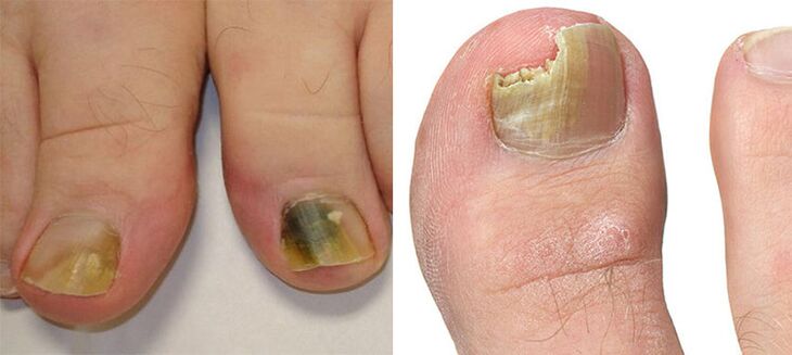 Onychomycosis - onddo batekin iltzeak suntsitzea