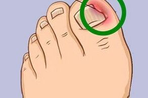 azazkala barneratua oinetako onddoaren ondorioz