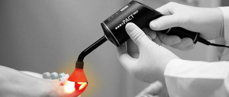 oinetako azazkalen onddoen laser tratamendua